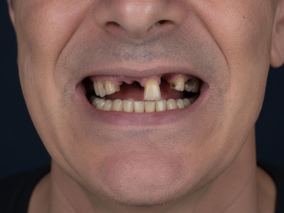 Illustrative smile before implant treatment — Worn smile, fully restored